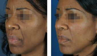 Fillers To Cheeks 928968