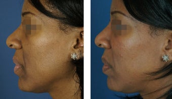 Fillers To Cheeks 928968