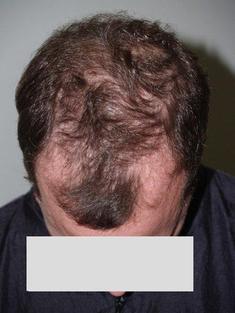 Hair Transplant before 199351
