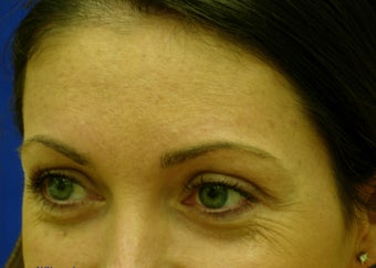 crows feet before 837687