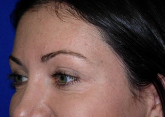 crows feet after 837687