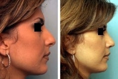 Rhinoplasty after 143652