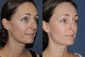 Before & After Fraxel Dual Treatment after 806238