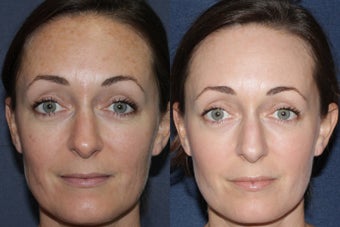 Before & After Fraxel Dual Treatment before 806238
