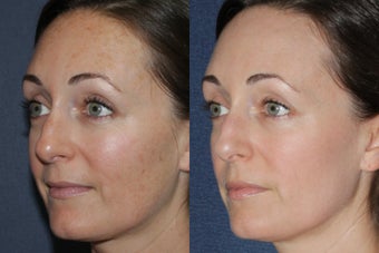 Before & After Fraxel Dual Treatment 806238
