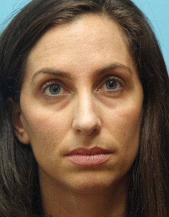 Eye Dermafillers,Cheek Dermafillers,Facial Dermafillers before 441945