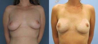 Breast Reconstruction before 1099712