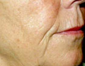 Mesotherapy before 920818