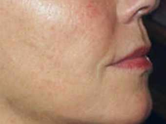 Mesotherapy after 920818