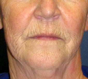 Chemical Peel 925600