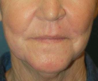 Chemical Peel 925600