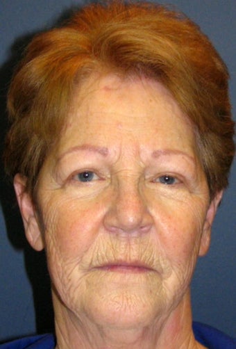 Chemical Peel before 925600