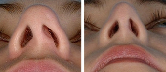 Functional Rhinoplasty before 1208310