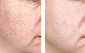 TCA Chemical Peel with 35% TCA before 6346