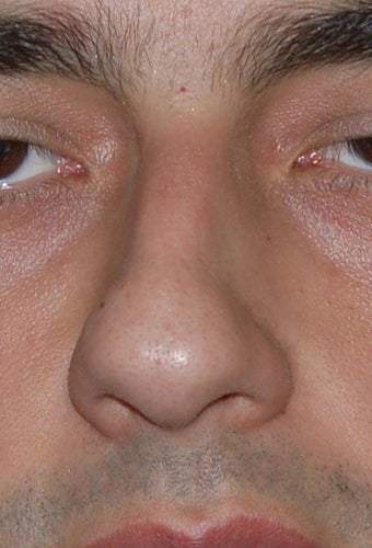 Rhinoplasty, Deviated Septum before 136232