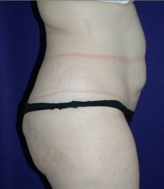 Tummy Tuck (abdominoplasty) 208484