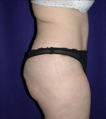 Tummy Tuck (abdominoplasty) 208484