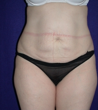 Tummy Tuck (abdominoplasty) before 208484