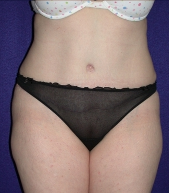 Tummy Tuck (abdominoplasty) after 208484
