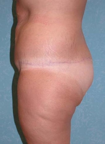 Buttock Augmentation with Circumferential Body Lift after 856909