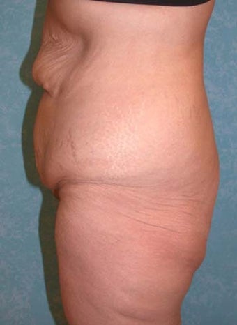 Buttock Augmentation with Circumferential Body Lift before 856909