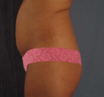 Brazilian Butt Lift before 656442