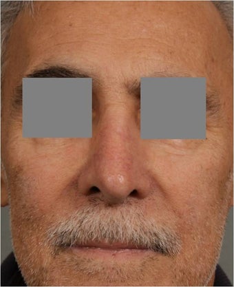 68 year old male with post rhinoplasty deformity prefers non surgical, "Injectable Rhinoplasty" treatment after 821702