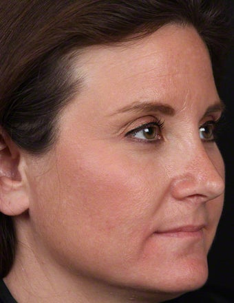 Cosmelan for Melasma after 539899