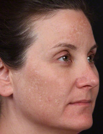 Cosmelan for Melasma before 539899