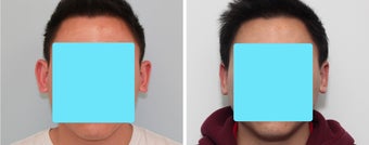 Otoplasty (Ear Surgery) Before and 2 Month After before 910627