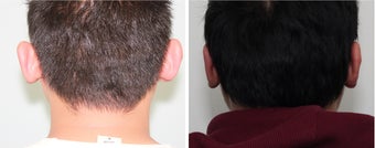 Otoplasty (Ear Surgery) Before and 2 Month After after 910627
