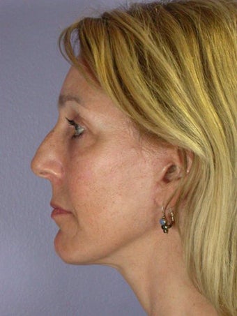 Eyelid Surgery after 280408