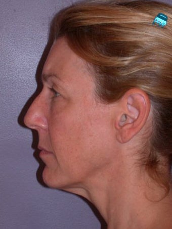Eyelid Surgery before 280408
