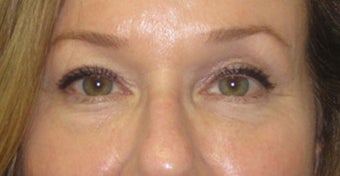 Lower lid bags treated with fillers to tear trough area and midface after 811389
