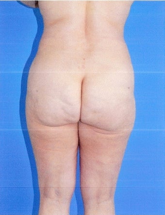 Liposuction after 499962