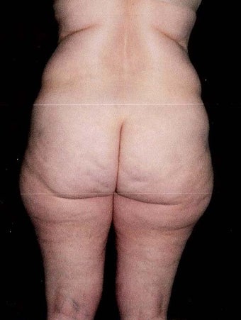 Liposuction before 499962