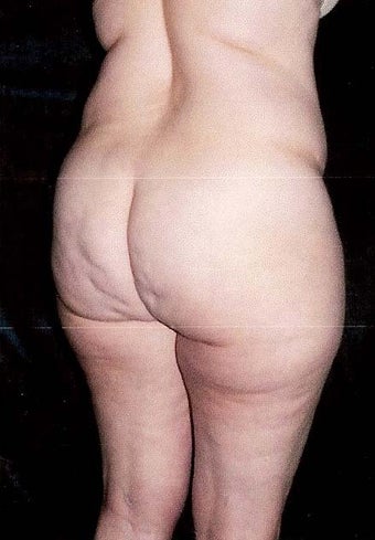 Liposuction 499962