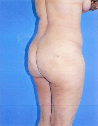 Liposuction 499962