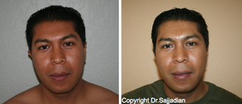 Ear Surgery before 1245312