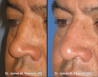 Rhinoplasty / Nasal Surgery after 910146