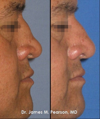 Rhinoplasty / Nasal Surgery before 910146