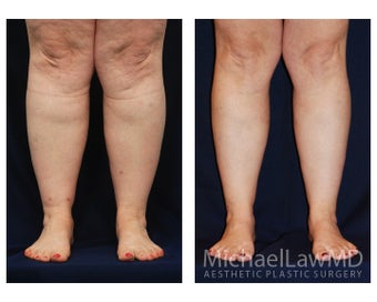 Lower Leg Liposuction before 904277