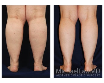 Lower Leg Liposuction 904277