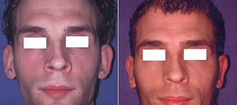 Otoplasty (correction of outstanding ears) before 110121