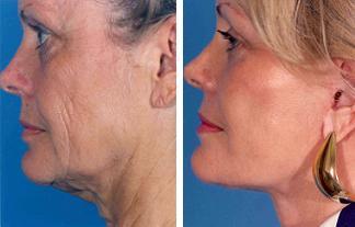 Facelift before 504986