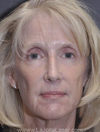 Sculptra before 227153