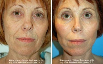 Facelift before 91420