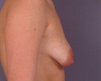 Breast Asymmetry Correction before 281333