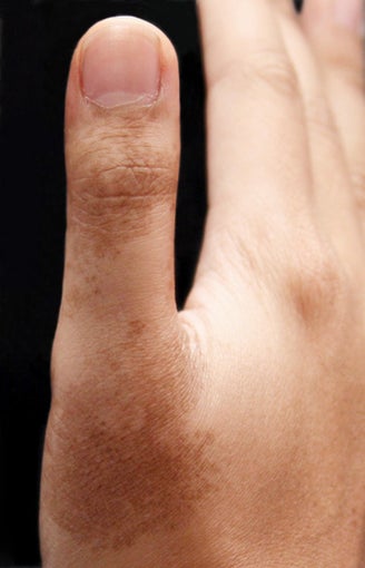 Alex Laser for Birthmark on Hand before 539861