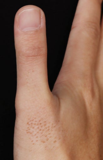 Alex Laser for Birthmark on Hand after 539861